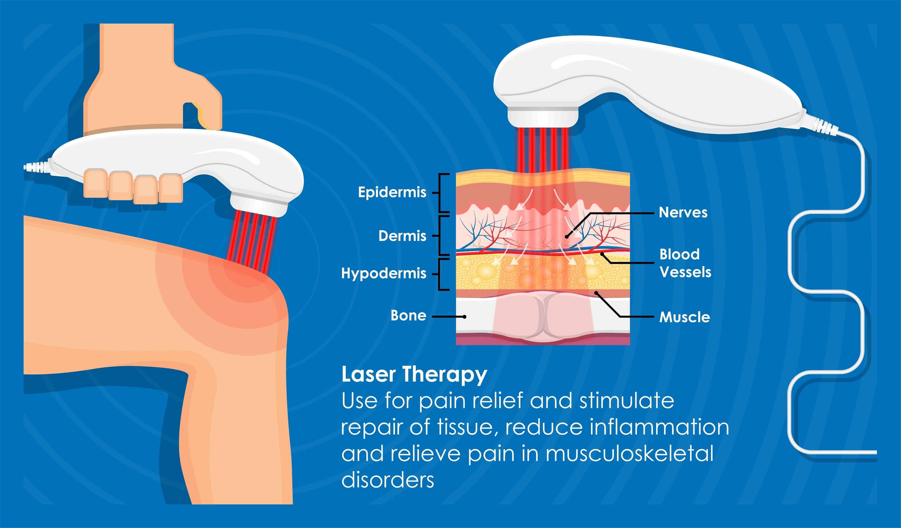 Plantar Fasciitis Shockwave Treatment in Provo Utah at Stronglife Physiotherapy